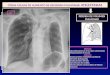 OTRAS CAUSAS DE AUMENTO DE DENSIDAD PULMONAR: ATELECTASIAS PÉRDIDA DE VOLUMEN PULMONAR Directos Opacidad pulmonar de la región atelectasiada Desplazamiento