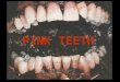 PINK TEETH. Pink Teeth HISTORIA 1829. Bell describe un fenómeno de coloración de los dientes después de un periodo de degradación del cuerpo que llama