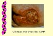Ulceras Por Presión: UPP. UPP: Otro Gran Síndrome Geriátrico MARCADOR DE FRAGILIDAD PREDICTOR DE MORTALIDAD INDICADOR DE CALIDAD ASISTENCIAL