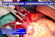 Dr. Julio Morón Castro Cirujano Cardiovascular Instituto Nacional del Corazón – INCOR Clinica San Pablo ENFERMEDAD CARDIOVASCULAR
