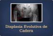 Displasia Evolutiva de Cadera. Generalidades Factores de riesgo Diagnóstico Prevención