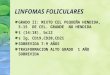 LINFOMAS FOLICULARES GRADO II: MIXTO CEL PEQUEÑA HENDIDA, 5- 15 DE CEL. GRANDE NO HENDIDA t (14:18), bcl2 s Ig, CD19,CD20,CD21 SOBREVIDA 7-9 AÑOS TRASFORMACION