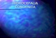 HIDROCEFALIA CONGENITA. DEFINICION Hydros= agua Hydros= agua Cephalus= cabeza Cephalus= cabeza Hidrocefalia congénita: Crecimiento progresivo ventricular