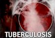 La tuberculosis Enfermedad crónica infectocontagiosa, causada por el complejo Mycobacterium tuberculosis, que afecta principalmente los pulmones (85%)