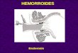 Esclerosis HEMORROIDES. Ligaduras Técnica de Barron