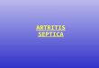 Artritis - Osteomielitis