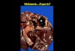 Melanosis…Especie?. Tromboembolia Trombo laminado