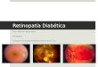 Retinopatia diabetica erc