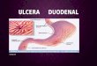 Ulcera     duodenal diap
