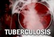 Tuberculosis Pulmonar, Extrapulmonar Y Taes
