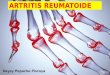 Artritis reumatoide