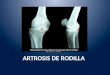 Artrosis de rodilla presentacion