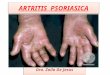 Artritis  psoriasica