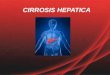 Cirrosis hepatica 2