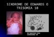 Sindrome de Edwards o Trisomia 18