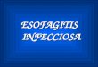 Esofagitis Infecciosa Expo