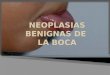 Neoplasias Benignas de la Boca