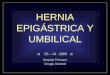 HERNIA UMBILICAL Y EPIGASTRICA