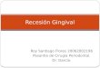 Recesión Gingival