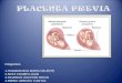 Placenta Previa Expo
