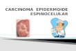 DERMATOLOGIA CARCINOMA EPIDERMOIDE ESPINOCELULAR