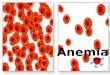 Anemia - Leucemia