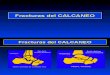04- Fracturas Del Calcaneo