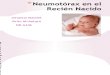 Neumotórax en el Recién Nacido