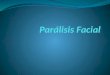 15 paralisis facial