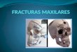 Fracturas maxilares