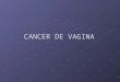 Cancer de vagina