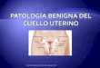 Patología benigna del cuello uterino