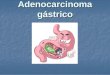 Adenocarcinoma gastrico