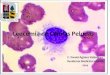 Leucemia Celulas Peludas. Tricoleucemia