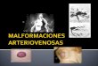 Malformaciones arteriovenosas[1]