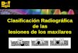 CLASIFICACION RADIOGRAFICA DE LESIONES DE LOS MAXILARES