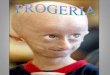 Progeria ppt 2013