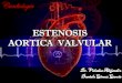 Estenosis aortica  valvular