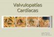 valvulopatias cardiacas