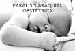 Paralisis braquial obstetrica