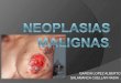 Neoplasias malignas