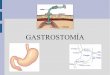 Gastrostomía: Definición, indicaciones, tipos, cuidados y complicaciones