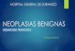 Neoplasias benignas desmoide cortical