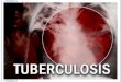 Tuberculosis microbiologia