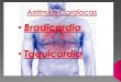 Arritmias - Bradicardia e Taquicardia