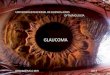 Glaucoma presentación