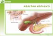 Caso clinico absceso hepatico