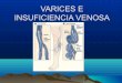 Varices e-insuficiencia venosa