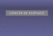 5. cáncer de esófago