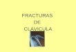 Fracturas De Clavicula